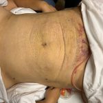 Post Liposuction Treatments in Boca Raton Florida
